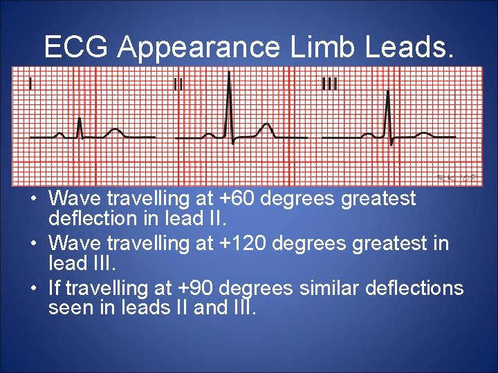 ECG Appearance Limb Leads. • Wave travelling at +60 degrees greatest deflection in lead