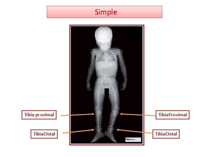  Simple Tibia proximal Tibia. Distal Tibia. Proximal Tibia. Distal 