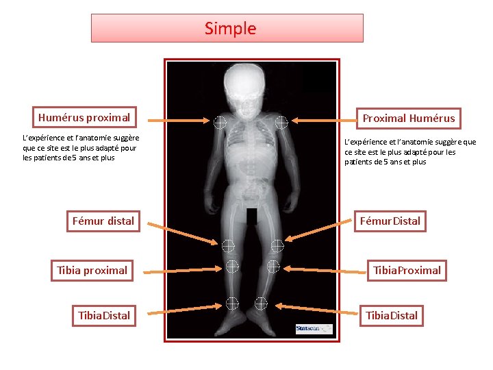  Simple Humérus proximal L’expérience et l’anatomie suggère que ce site est le plus