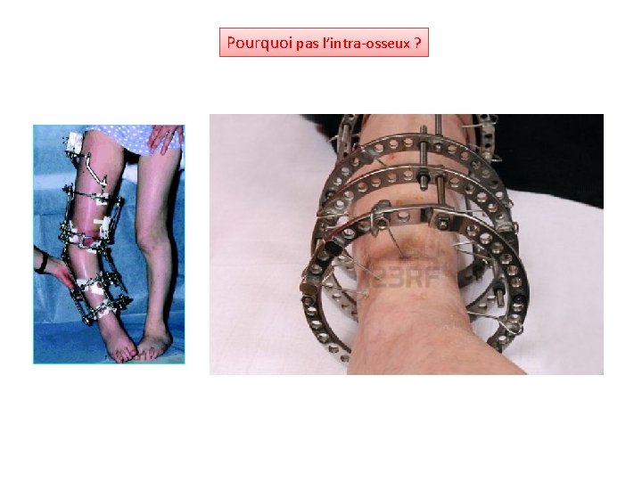 Pourquoi pas l’intra-osseux ? 