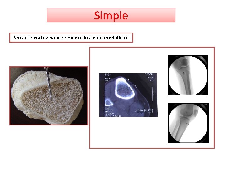 Simple Percer le cortex pour rejoindre la cavité médullaire 