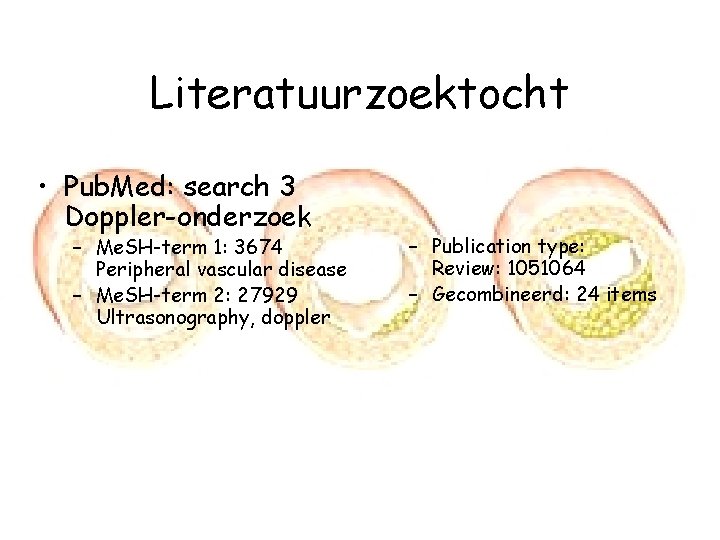 Literatuurzoektocht • Pub. Med: search 3 Doppler-onderzoek – Me. SH-term 1: 3674 Peripheral vascular