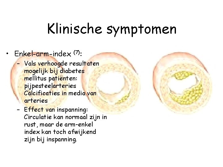 Klinische symptomen • Enkel-arm-index (7): – Vals verhoogde resultaten mogelijk bij diabetes mellitus patiënten: