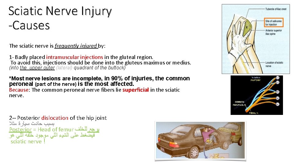 Sciatic Nerve Injury -Causes The sciatic nerve is frequently injured by: 1 - Badly