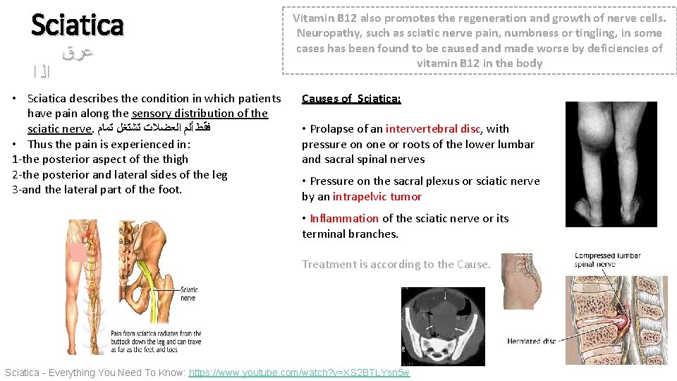 Sciatica ﺍﻟ ﺍ ﻋﺮﻕ • Sciatica describes the condition in which patients have pain