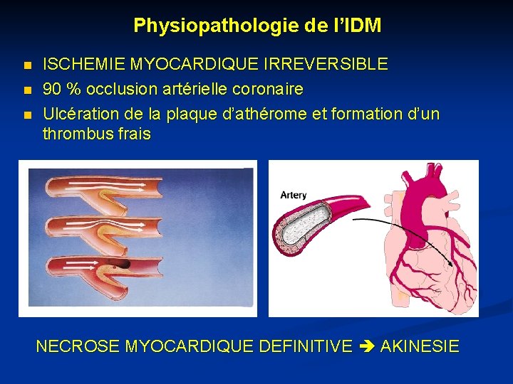 Physiopathologie de l’IDM n n n ISCHEMIE MYOCARDIQUE IRREVERSIBLE 90 % occlusion artérielle coronaire