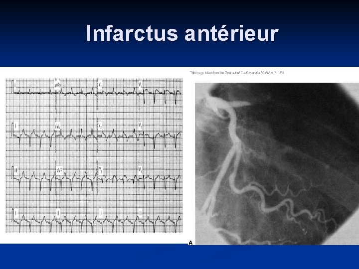 Infarctus antérieur 