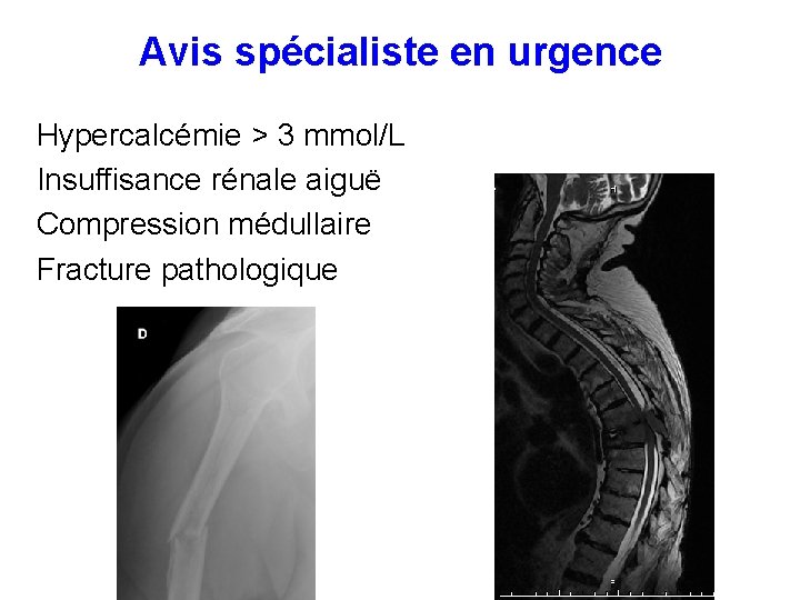 Avis spécialiste en urgence Hypercalcémie > 3 mmol/L Insuffisance rénale aiguë Compression médullaire Fracture