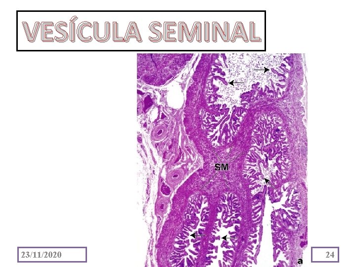 VESÍCULA SEMINAL 23/11/2020 24 