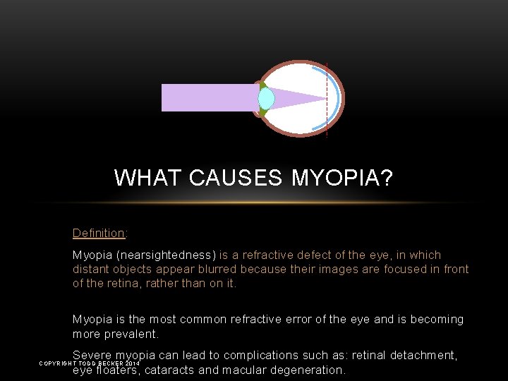 myopia pseudo)