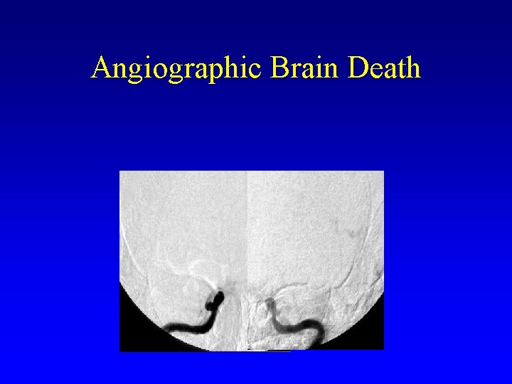 Angiographic Brain Death 