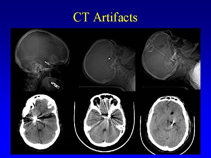 CT Artifacts 