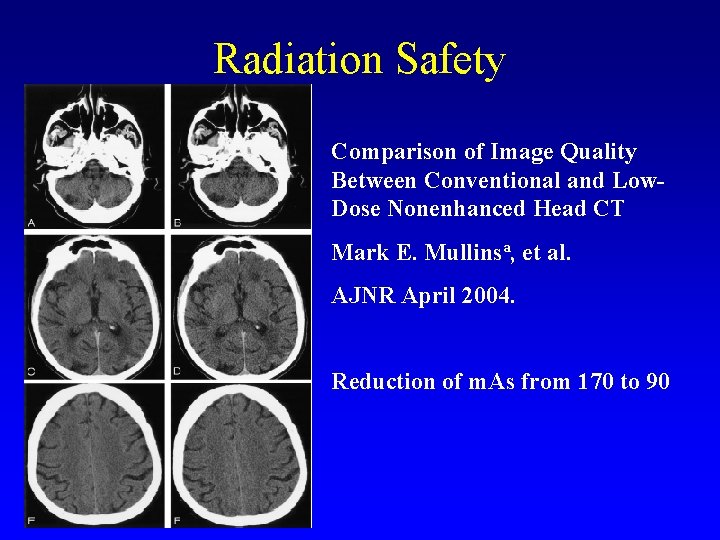 Radiation Safety Comparison of Image Quality Between Conventional and Low. Dose Nonenhanced Head CT