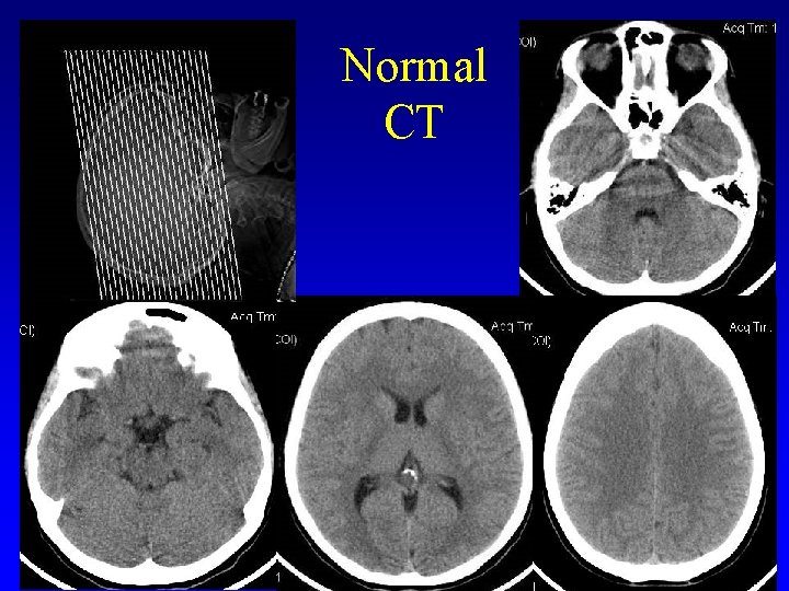 Normal CT 