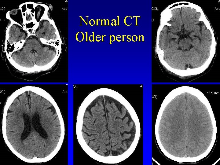 Normal CT Older person 