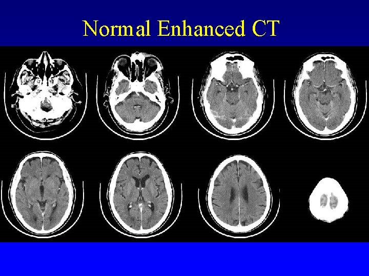Normal Enhanced CT 