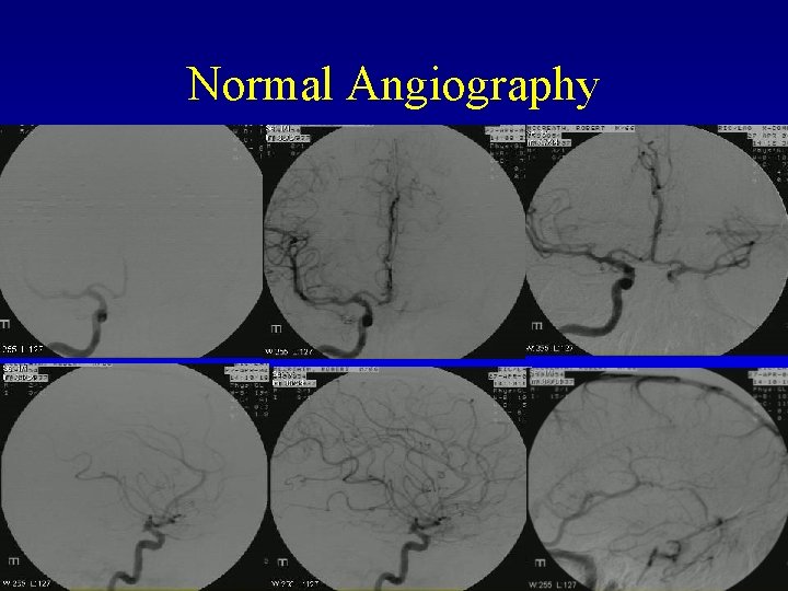 Normal Angiography 