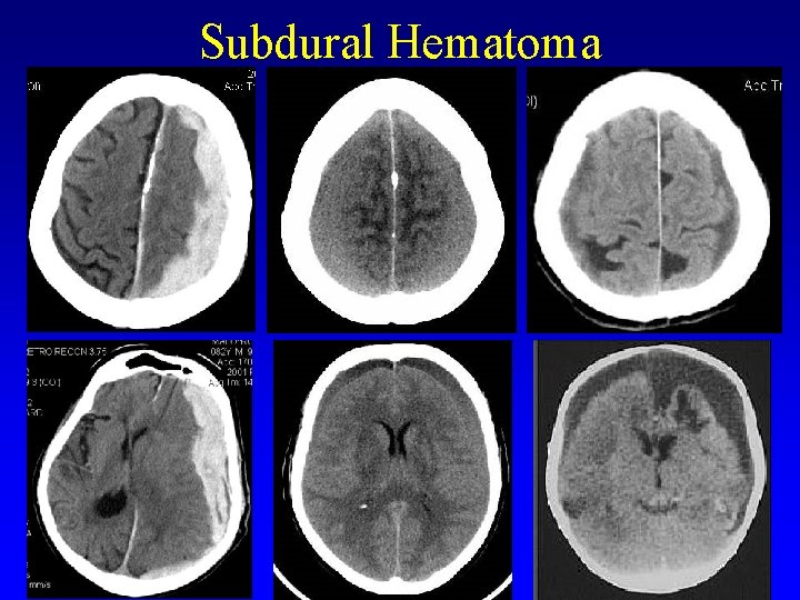 Subdural Hematoma 