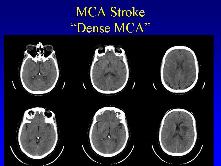 MCA Stroke “Dense MCA” 