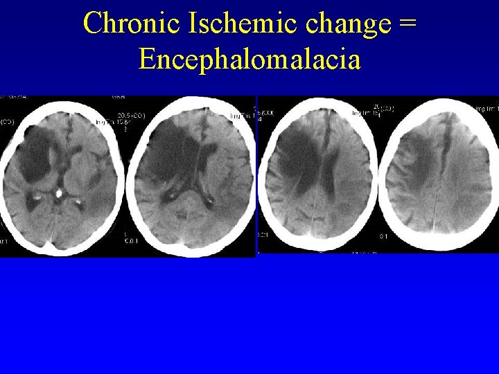 Chronic Ischemic change = Encephalomalacia 