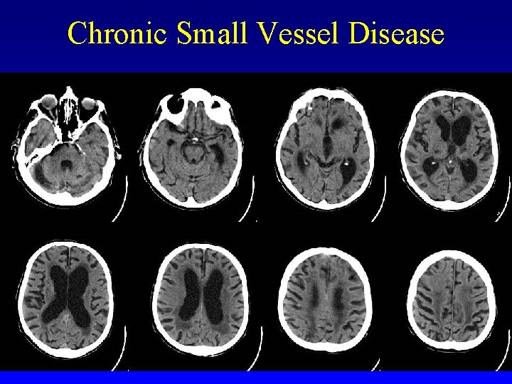 Chronic Small Vessel Disease 