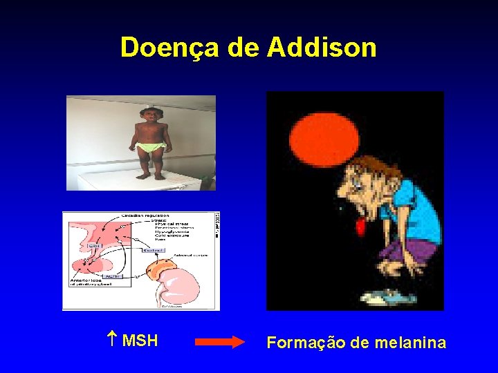 Doença de Addison MSH Formação de melanina 