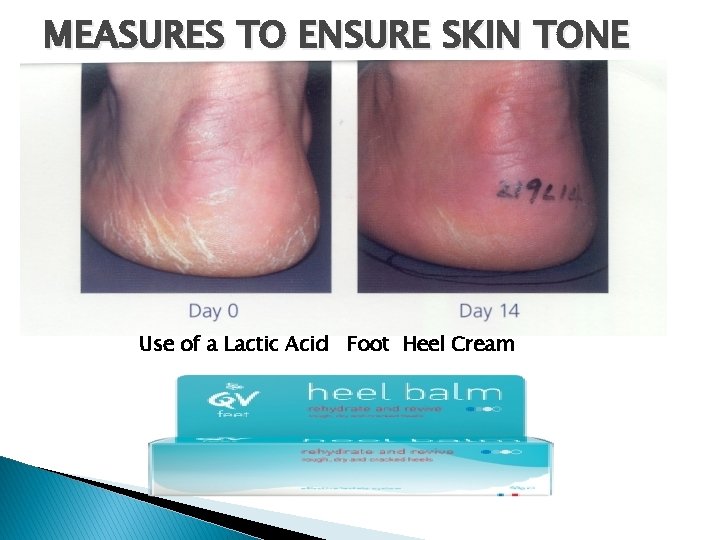 MEASURES TO ENSURE SKIN TONE Use of a Lactic Acid Foot Heel Cream MEASURES TO ENSURE SKIN TONE Use of a Lactic Acid Foot Heel Cream