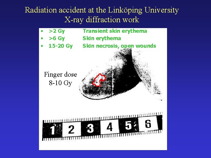 Radiation accident at the Linköping University X-ray diffraction work • • • >2 Gy