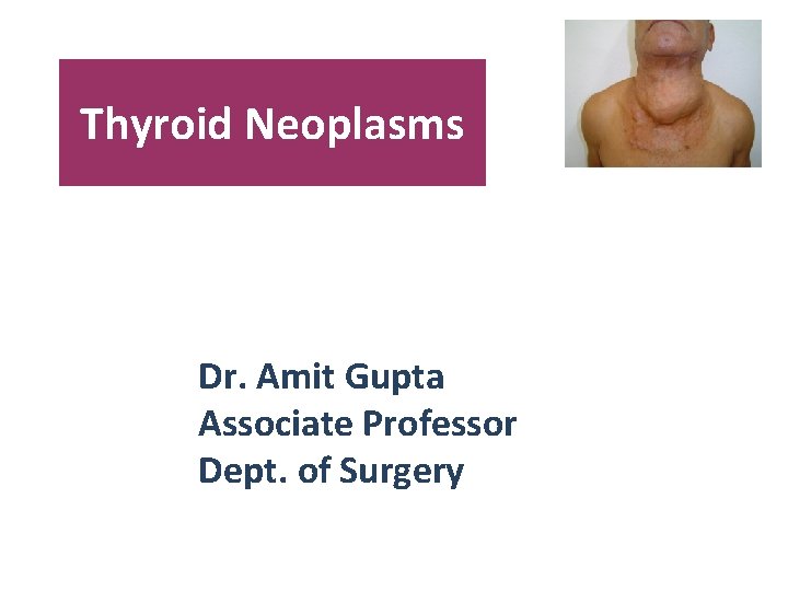 Thyroid Neoplasms Dr. Amit Gupta Associate Professor Dept. of Surgery 