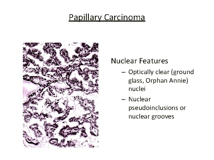 Papillary Carcinoma Nuclear Features – Optically clear (ground glass, Orphan Annie) nuclei – Nuclear