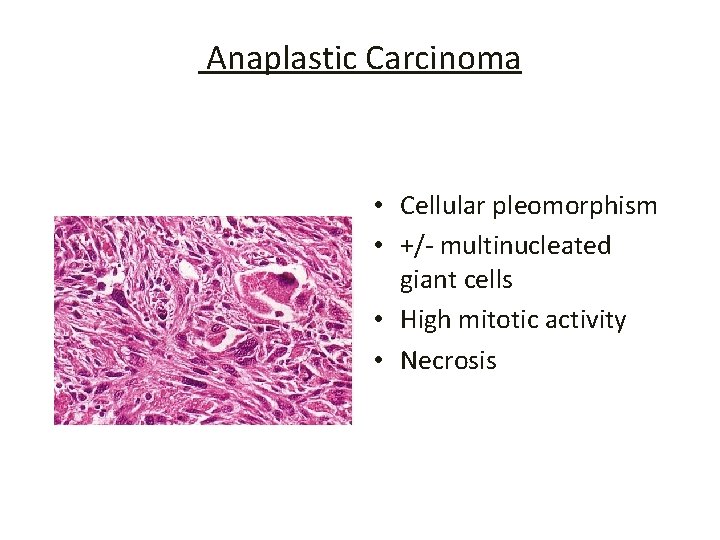 Anaplastic Carcinoma • Cellular pleomorphism • +/- multinucleated giant cells • High mitotic activity