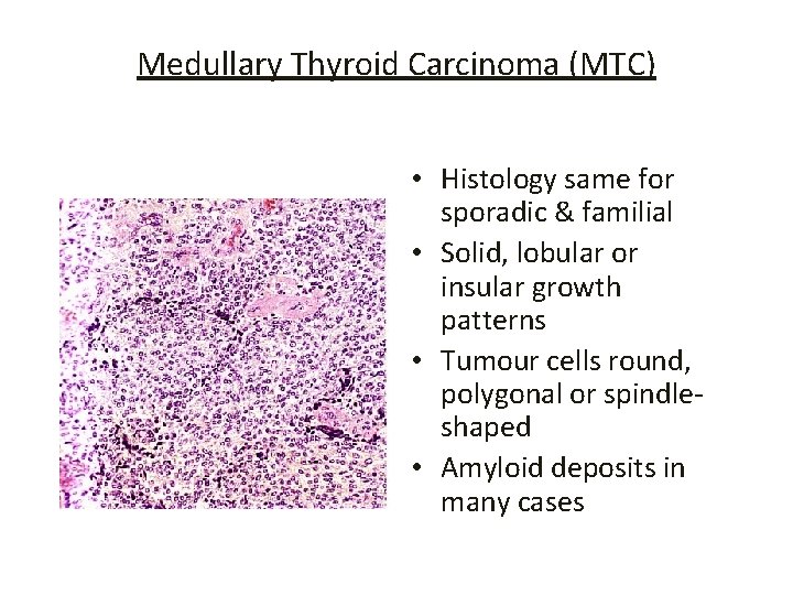 Medullary Thyroid Carcinoma (MTC) • Histology same for sporadic & familial • Solid, lobular