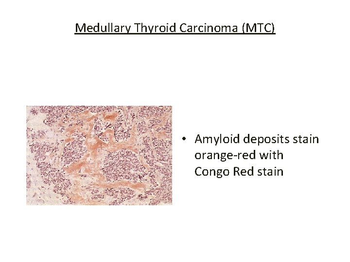 Medullary Thyroid Carcinoma (MTC) • Amyloid deposits stain orange-red with Congo Red stain 