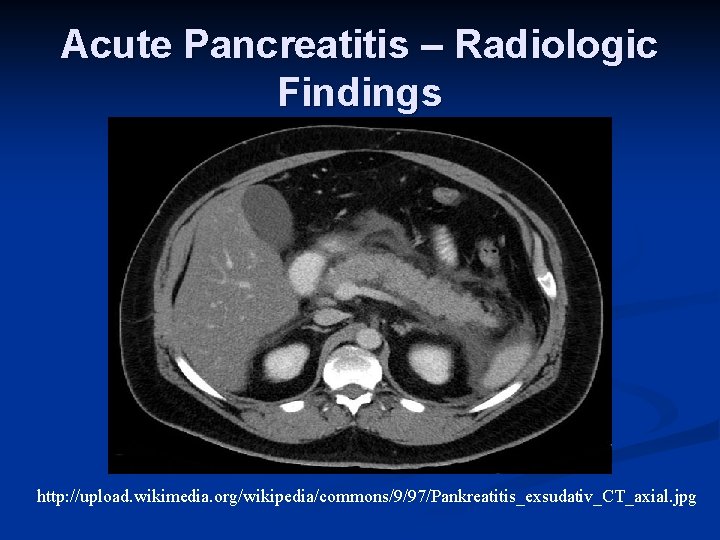 Acute Pancreatitis – Radiologic Findings http: //upload. wikimedia. org/wikipedia/commons/9/97/Pankreatitis_exsudativ_CT_axial. jpg 
