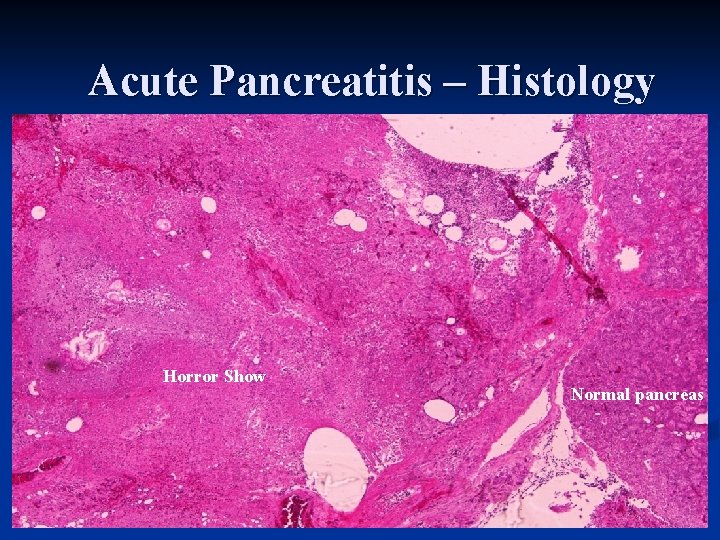 Acute Pancreatitis – Histology Horror Show Normal pancreas 