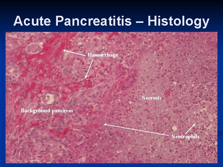 Acute Pancreatitis – Histology Hemorrhage Necrosis Background pancreas Neutrophils 