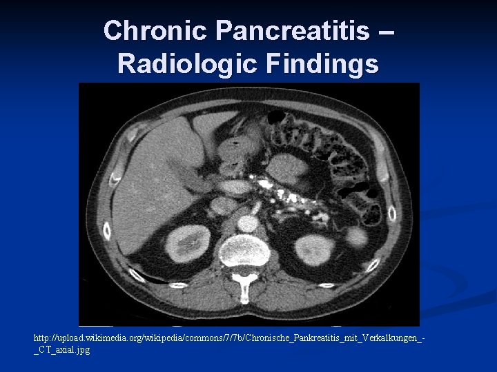 Chronic Pancreatitis – Radiologic Findings http: //upload. wikimedia. org/wikipedia/commons/7/7 b/Chronische_Pankreatitis_mit_Verkalkungen__CT_axial. jpg 