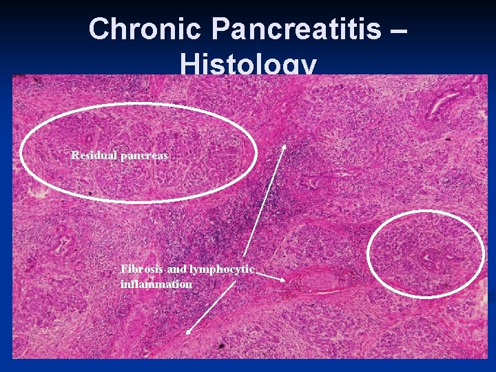 Chronic Pancreatitis – Histology Residual pancreas Fibrosis and lymphocytic inflammation 