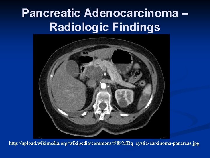 Pancreatic Adenocarcinoma – Radiologic Findings http: //upload. wikimedia. org/wikipedia/commons/f/f 6/MBq_cystic-carcinoma-pancreas. jpg 