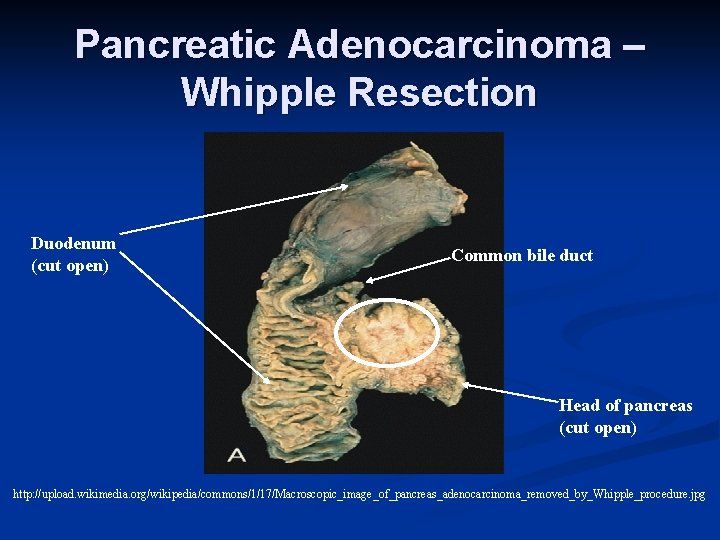 Pancreatic Adenocarcinoma – Whipple Resection Duodenum (cut open) Common bile duct Head of pancreas