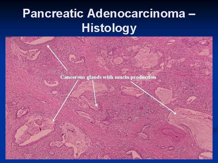 Pancreatic Adenocarcinoma – Histology Cancerous glands with mucin production 