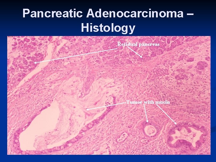 Pancreatic Adenocarcinoma – Histology Residual pancreas Tumor with mucin 