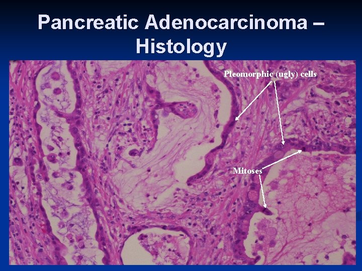 Pancreatic Adenocarcinoma – Histology Pleomorphic (ugly) cells Mitoses 