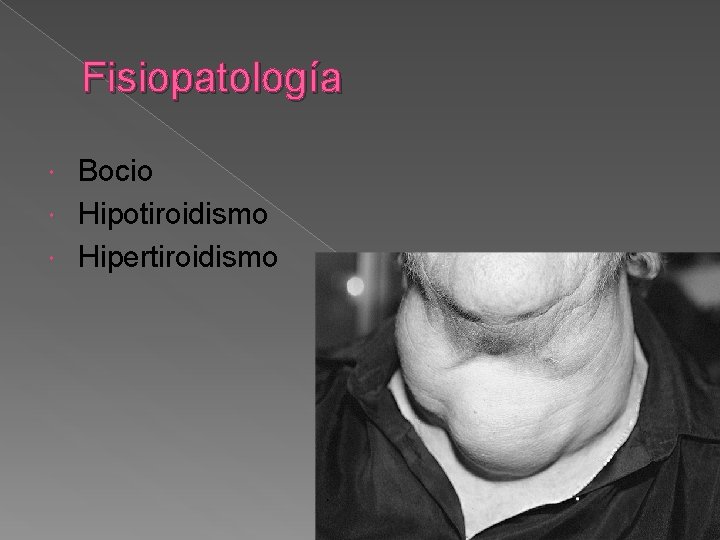 Fisiopatología Bocio Hipotiroidismo Hipertiroidismo 