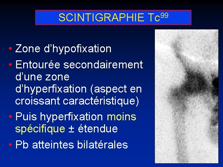 SCINTIGRAPHIE Tc 99 • Zone d’hypofixation • Entourée secondairement d’une zone d’hyperfixation (aspect en