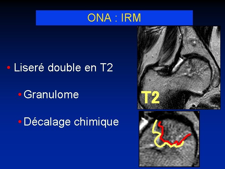 ONA : IRM • Liseré double en T 2 • Granulome • Décalage chimique