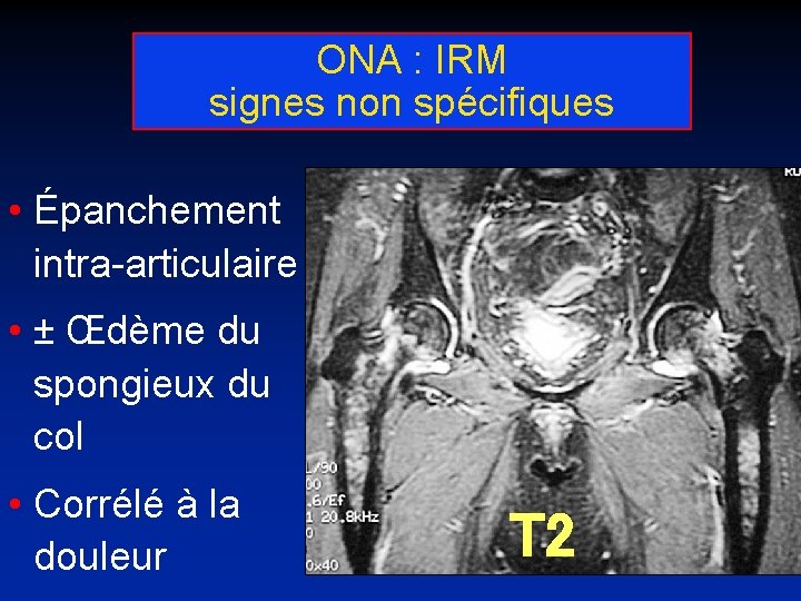 ONA : IRM signes non spécifiques • Épanchement intra-articulaire • ± Œdème du spongieux