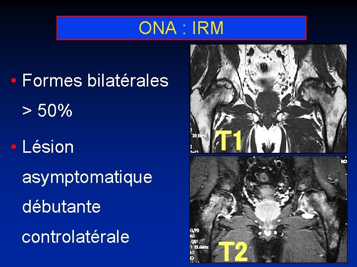 ONA : IRM • Formes bilatérales > 50% • Lésion T 1 asymptomatique débutante