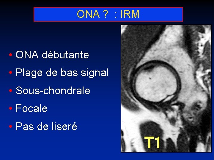 ONA ? : IRM • ONA débutante • Plage de bas signal • Sous-chondrale