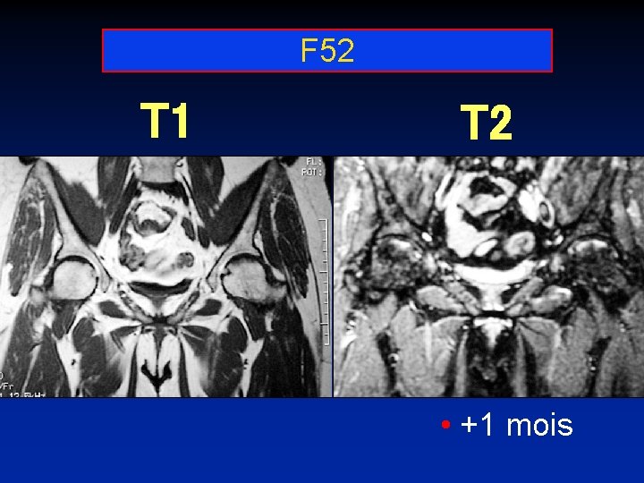 F 52 T 1 T 2 • +1 mois 